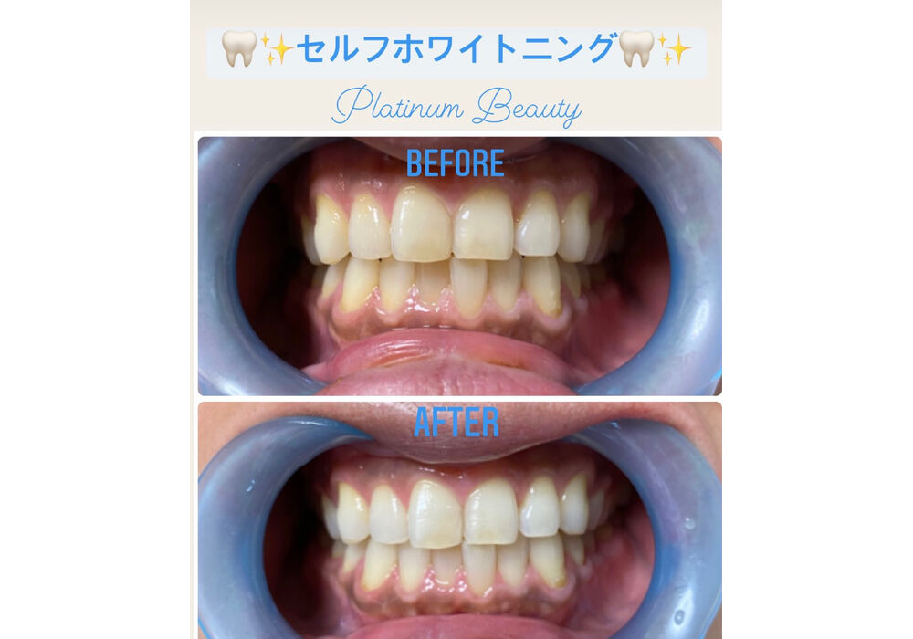 セルフホワイトニング　赤羽
