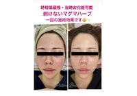 剥けないハーブピーリング